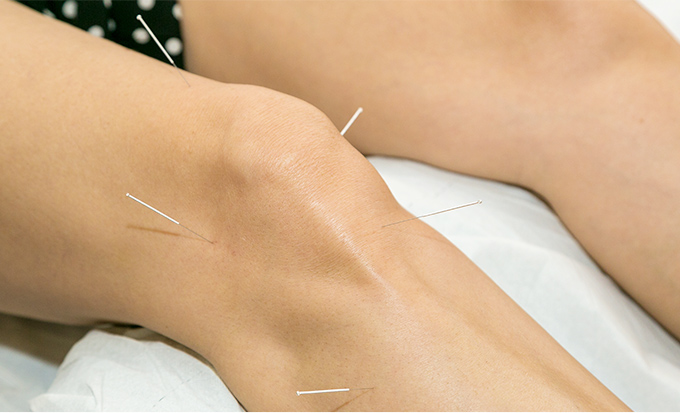 鍼灸治療の様子